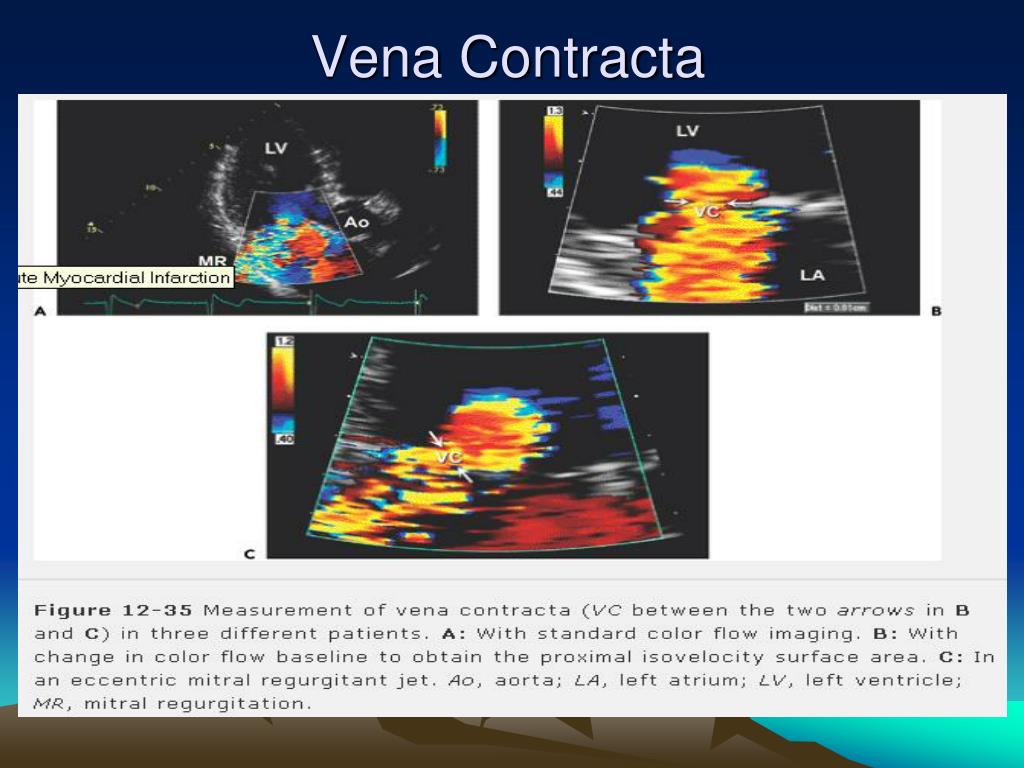 PPT MITRAL REGURGITATION PowerPoint Presentation, free download ID