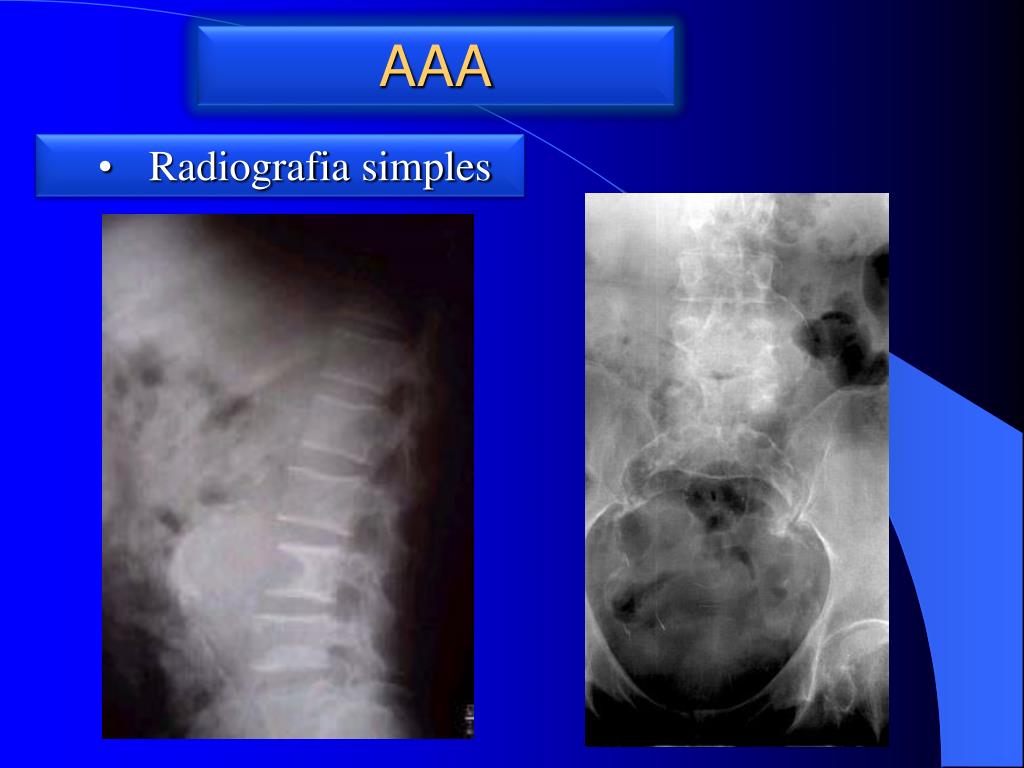 PPT ANEURISMA DA AORTA ABDOMINAL AAA PowerPoint Presentation, free