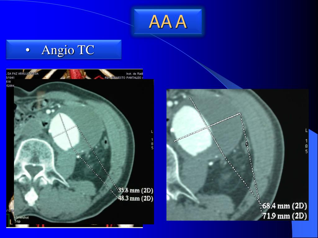 PPT ANEURISMA DA AORTA ABDOMINAL AAA PowerPoint Presentation, free