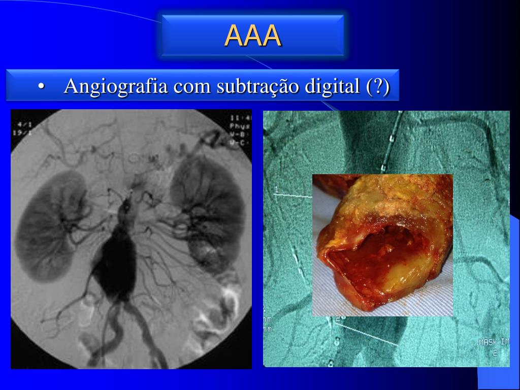 PPT ANEURISMA DA AORTA ABDOMINAL AAA PowerPoint Presentation, free