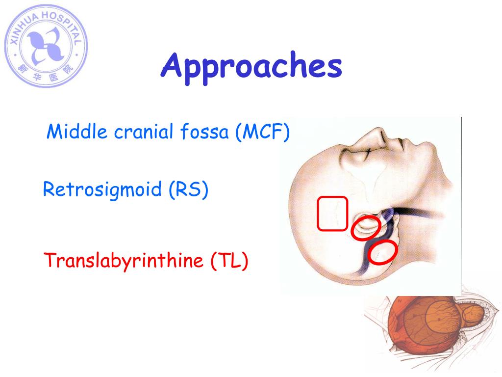 PPT Acoustic neuroma surgery —Shanghai experience PowerPoint