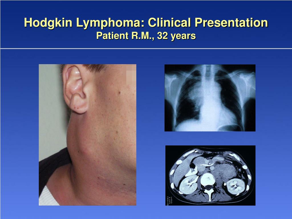 PPT New aspects in the treatment of Hodgkin Lymphoma PowerPoint