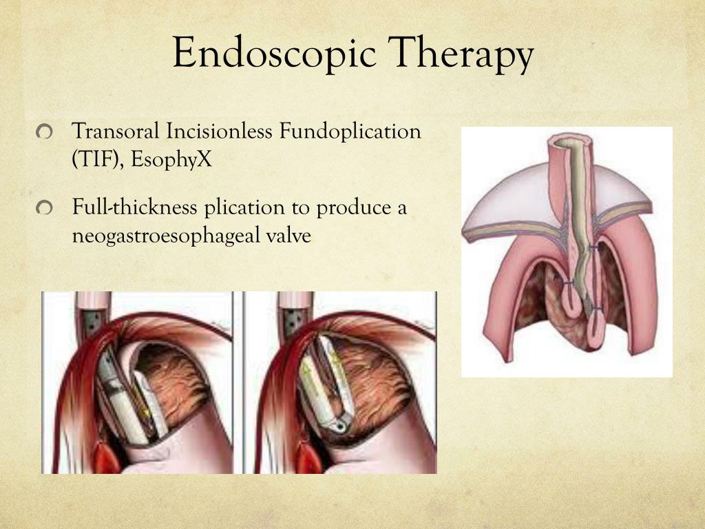 PPT The NonMedical Treatments of the Gastroesophageal Reflux Disease
