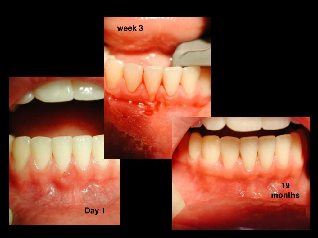 PPT Periodontal Aesthetics PowerPoint Presentation, free