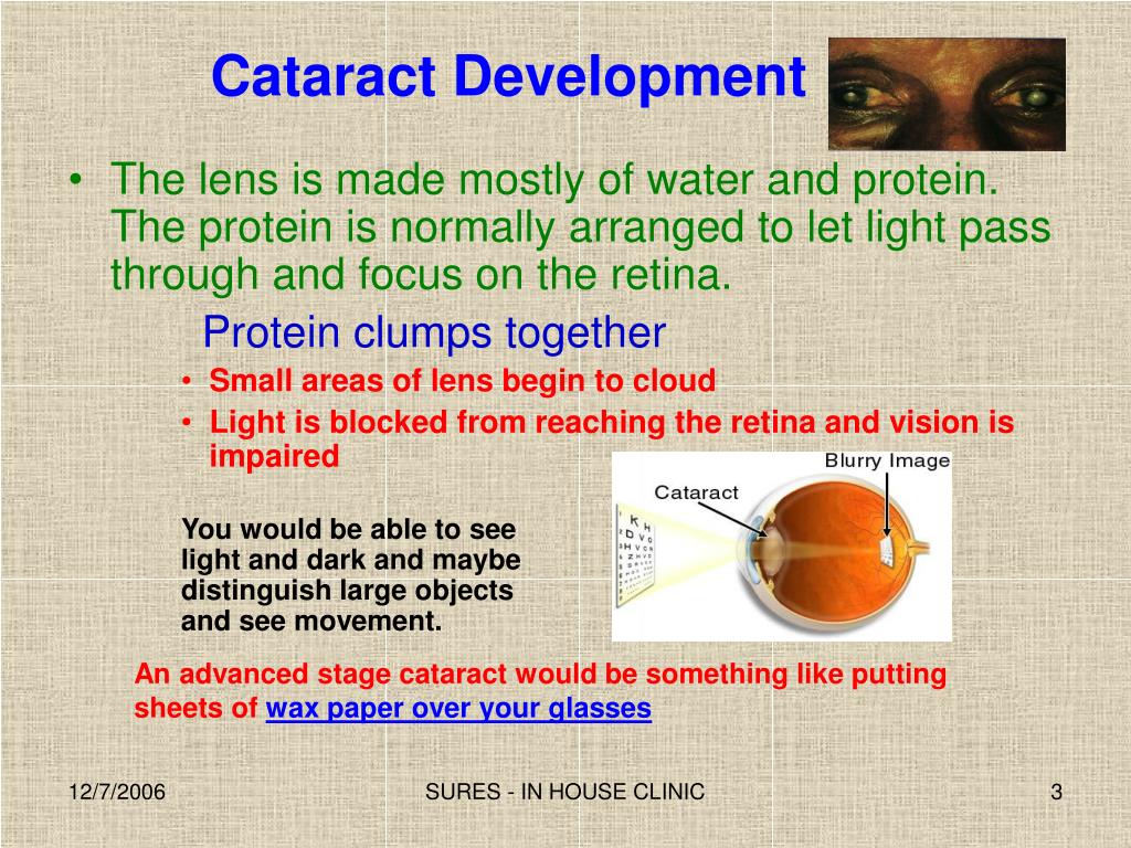 PPT Cataract PowerPoint Presentation, free download ID4916318