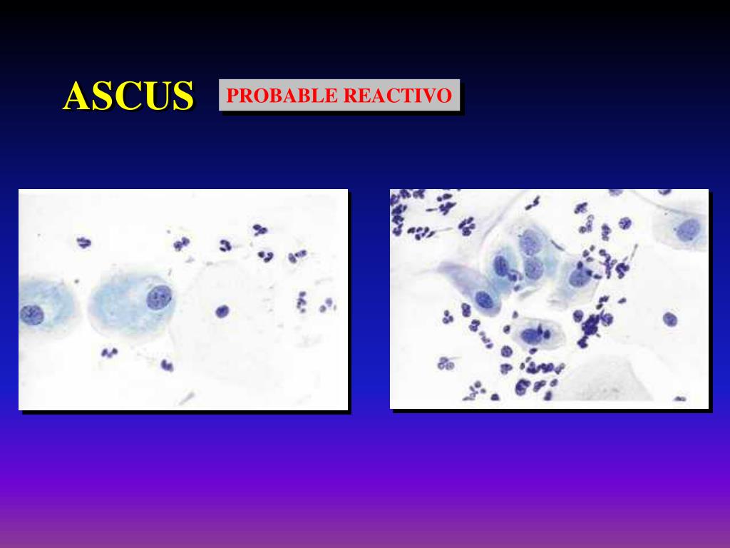 PPT ASCUS ¿Diagnóstico o prevención? PowerPoint Presentation, free