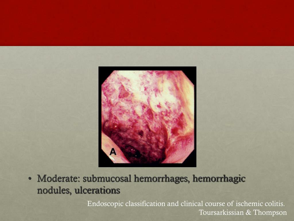 PPT Colonic Ischemia What really matters? PowerPoint Presentation