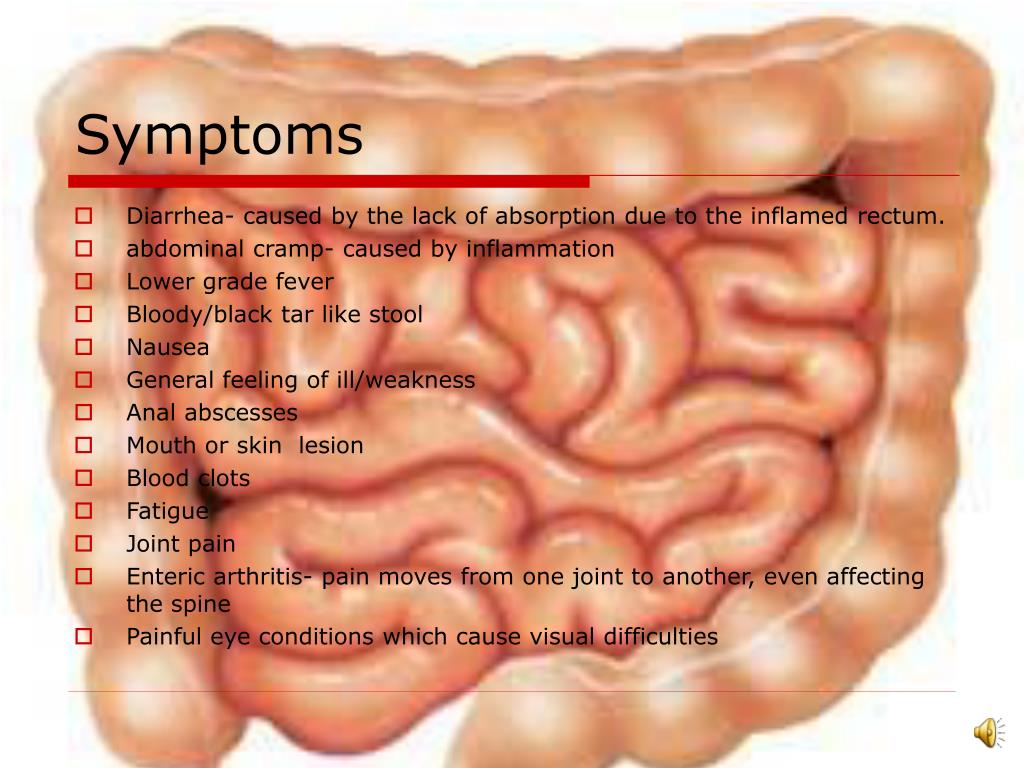 PPT Crohn’s Disease PowerPoint Presentation, free download ID4954621