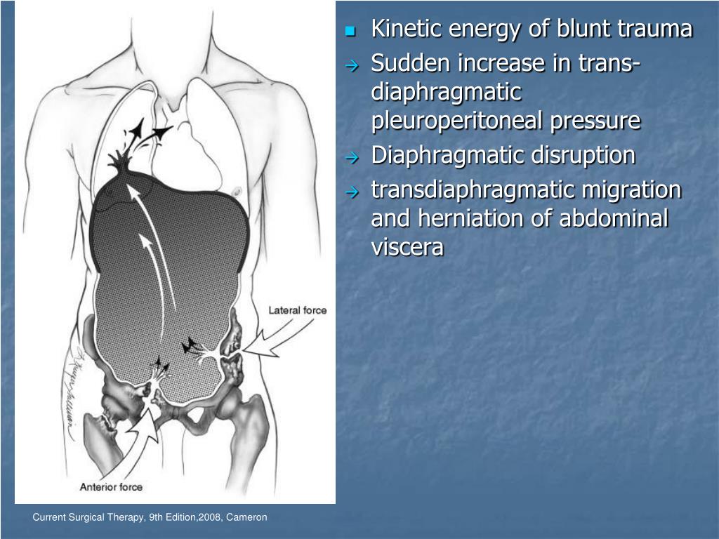 PPT Diaphragmatic injury PowerPoint Presentation, free download ID