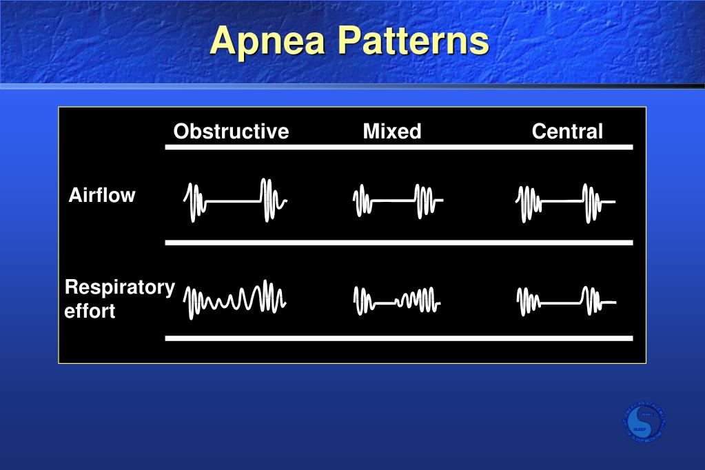 PPT Pediatric Obstructive Sleep Apnea Syndrome Kids are not simply