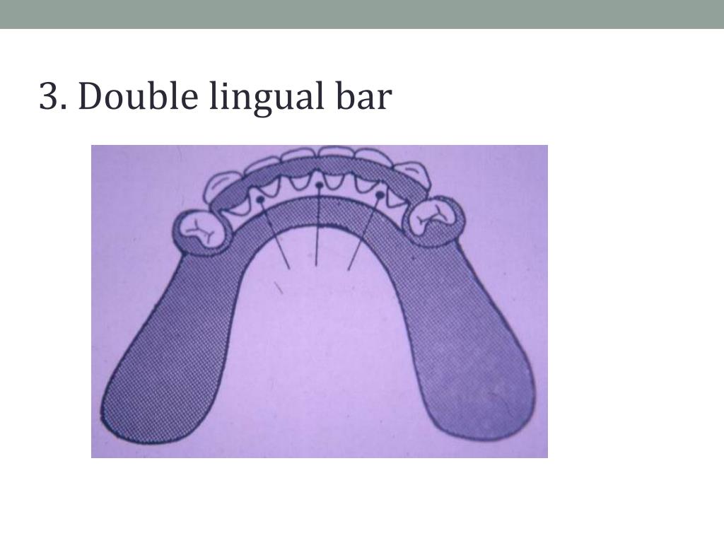 PPT Planning the design for removable partial dentures (part 2) PowerPoint Presentation ID