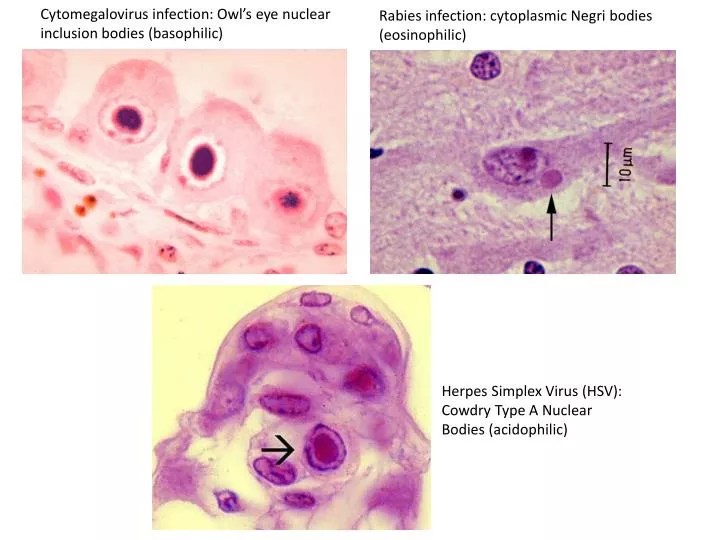 PPT Cytomegalovirus infection Owl’s eye nuclear inclusion bodies