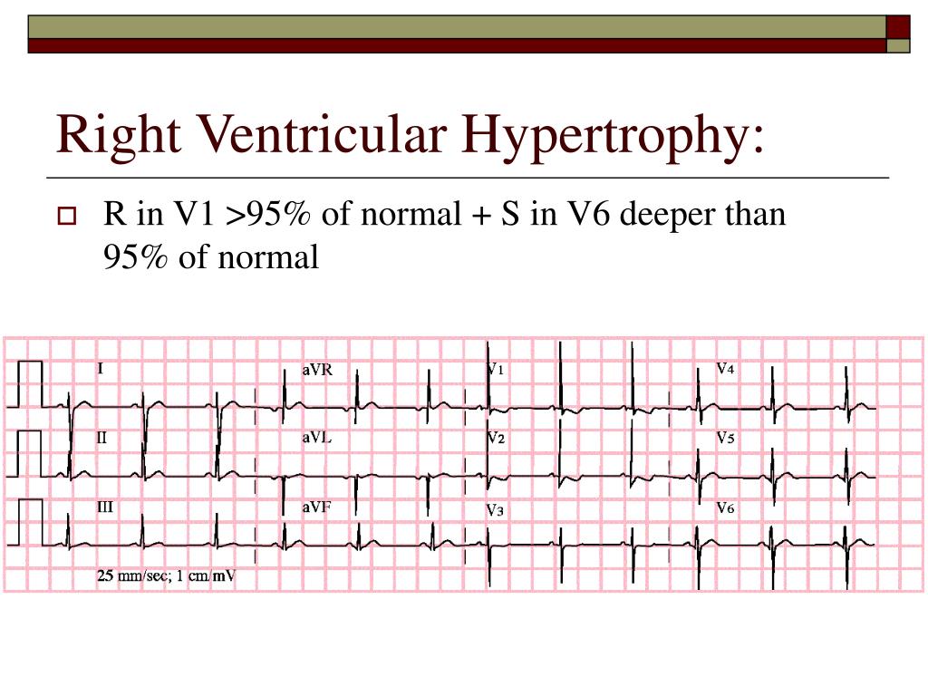 PPT ECG Rounds PowerPoint Presentation, free download ID5098779