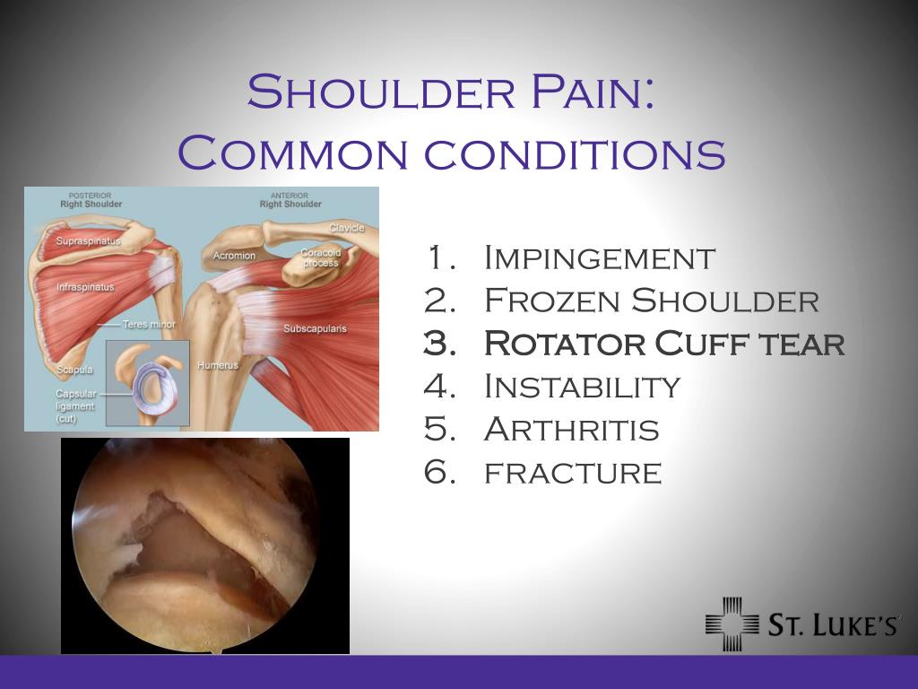 Shoulder Injuries and Disorders Pictures
