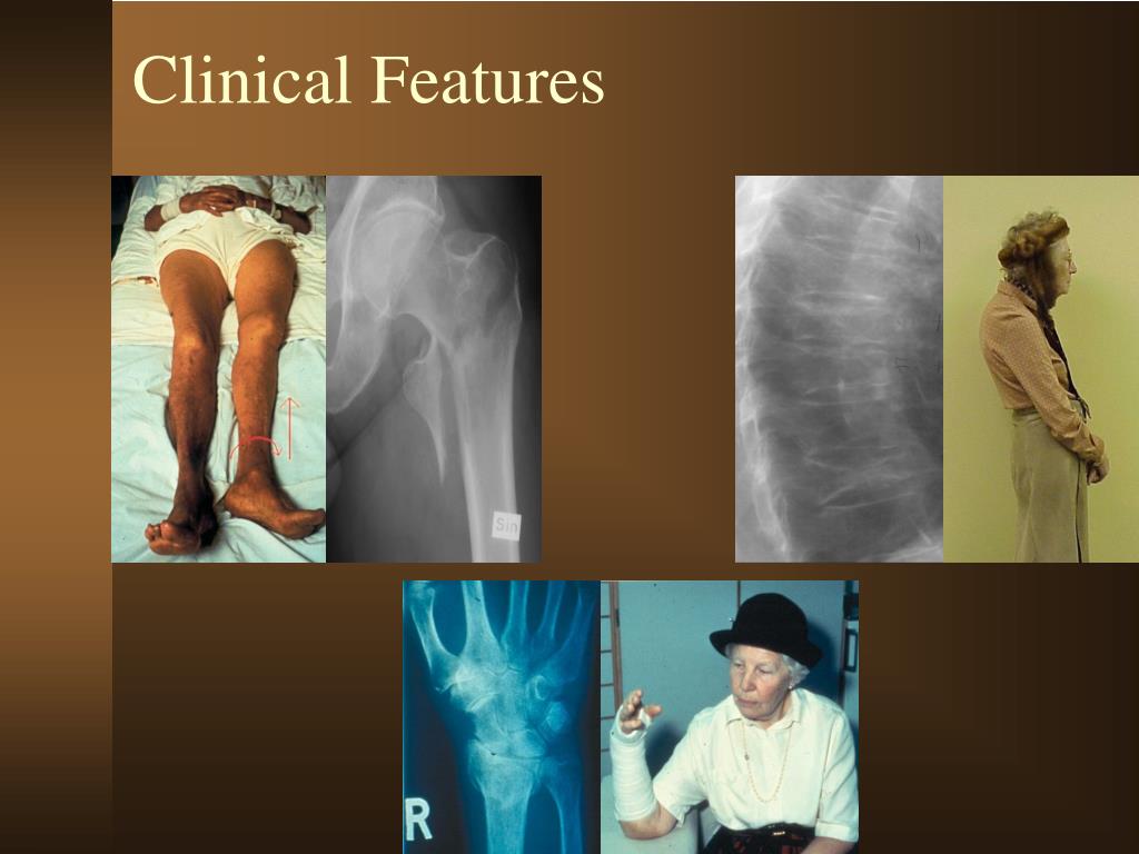 PPT Epidemiology of Osteoporosis PowerPoint Presentation