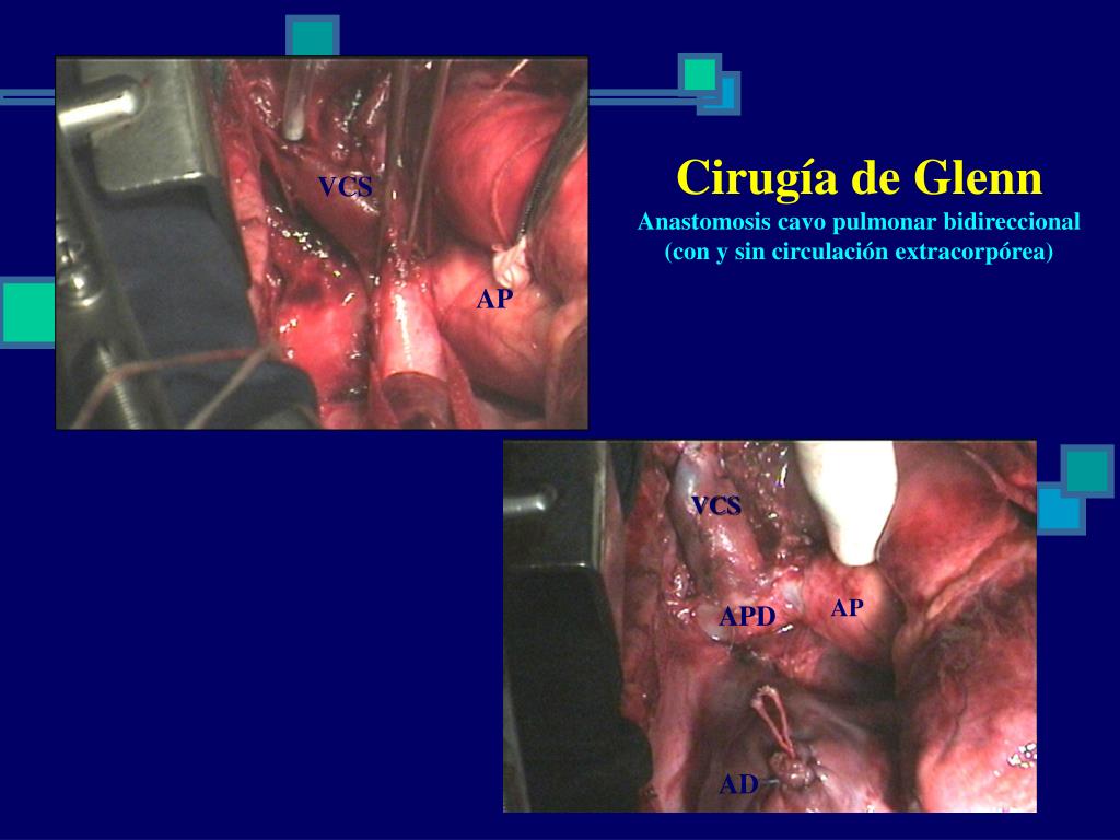 PPT Cardiopatías Congénitas Cianóticas Manejo Quirúrgico PowerPoint