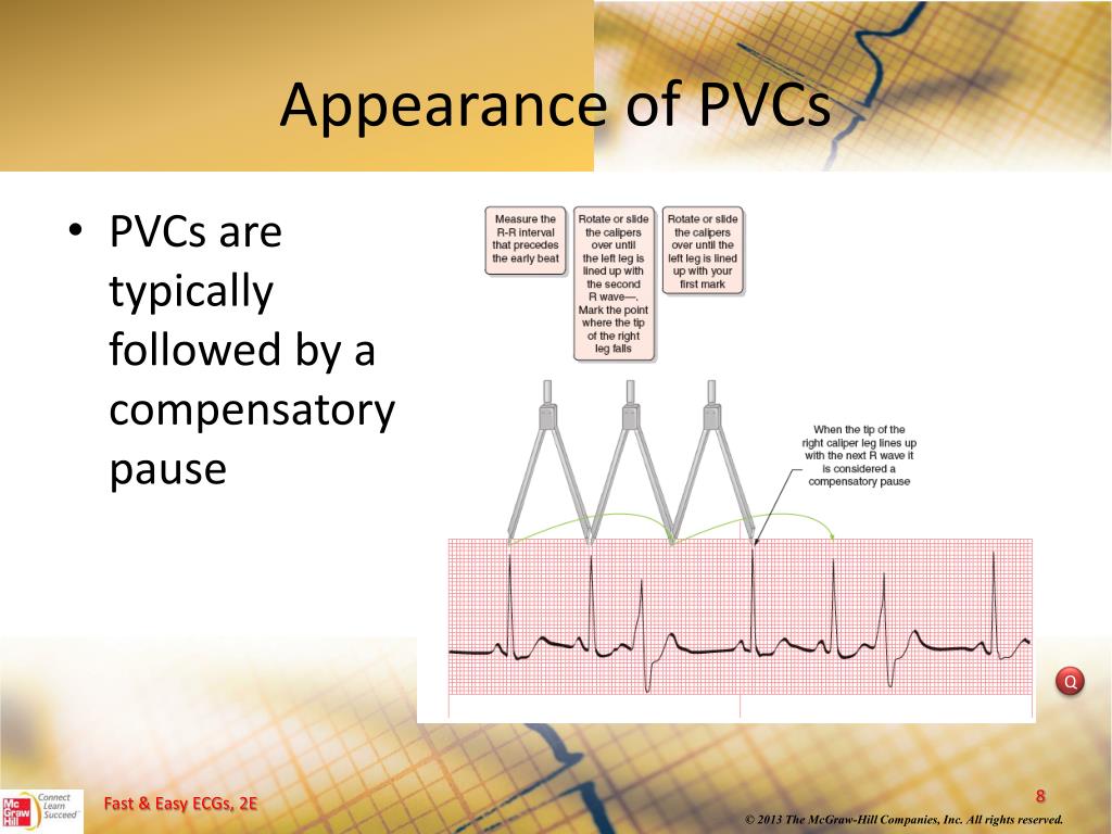 PPT Ventricular Dysrhythmias PowerPoint Presentation, free download