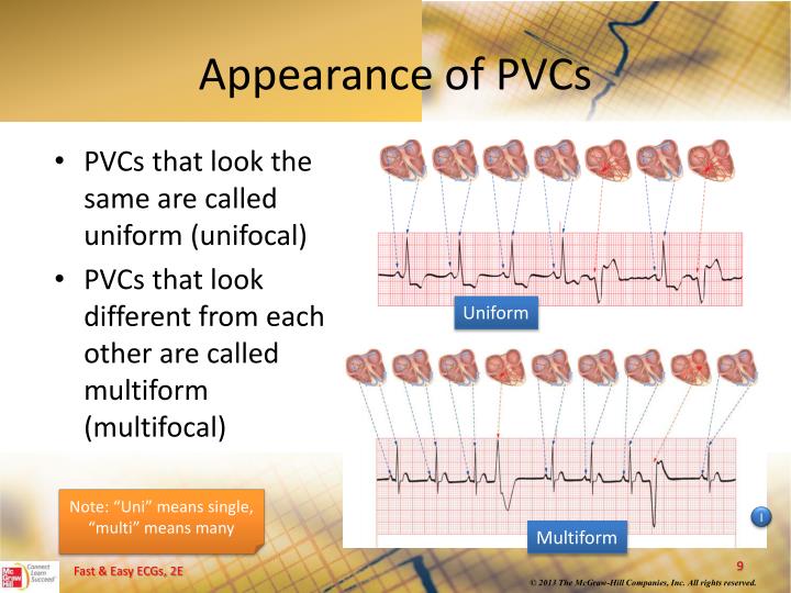 Can Cancer Cause Pvcs at Marjorie McLaurin blog