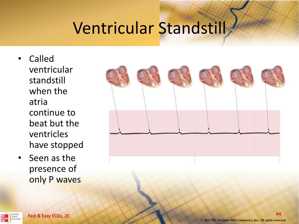 PPT Ventricular Dysrhythmias PowerPoint Presentation, free download ID5204970