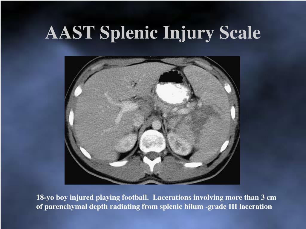 PPT Management of Spleen/Liver Trauma PowerPoint Presentation, free