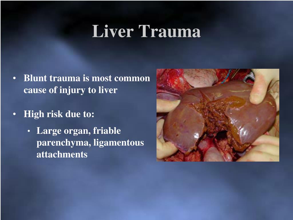 PPT Management of Spleen/Liver Trauma PowerPoint Presentation, free