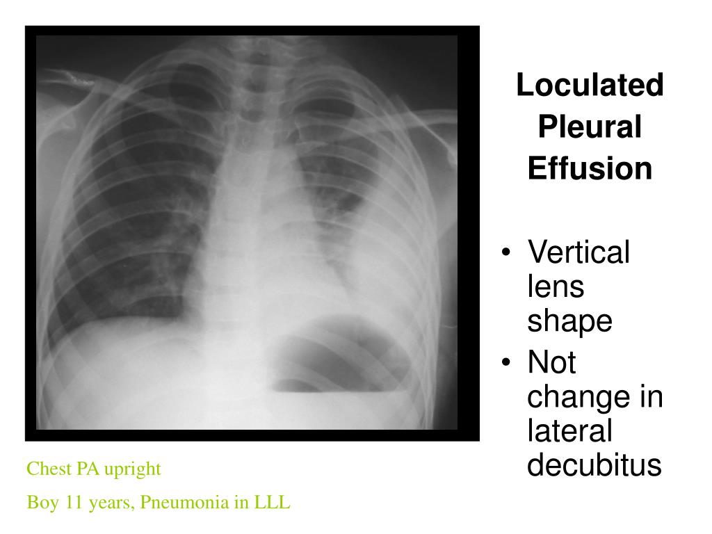 Loculated Pleural Effusion Pleural effusion Postgraduate Medical