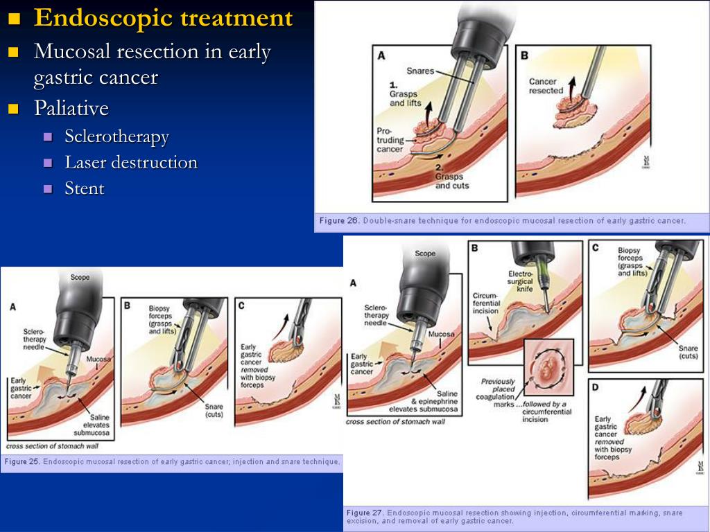 PPT GASTRIC CANCER PowerPoint Presentation, free download ID5311342