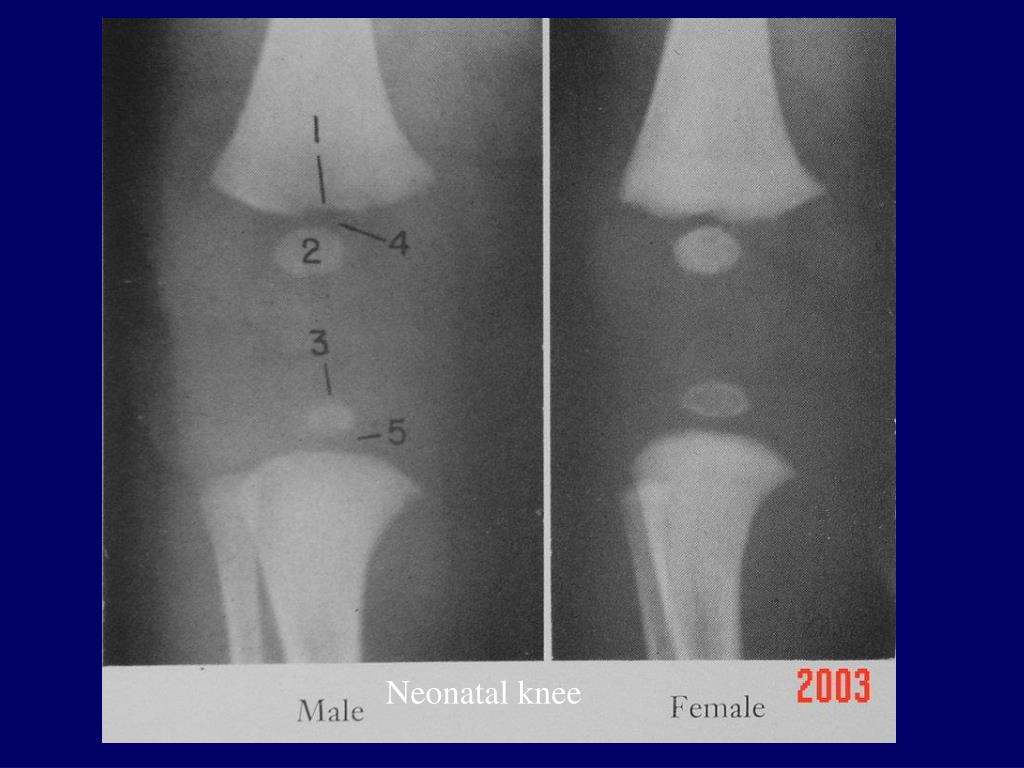 PPT Radiographic Atlas of the Skeletal Development of the Knee