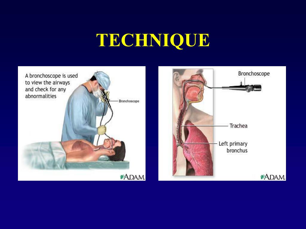 PPT BRONCHOSCOPY PowerPoint Presentation, free download ID5317592