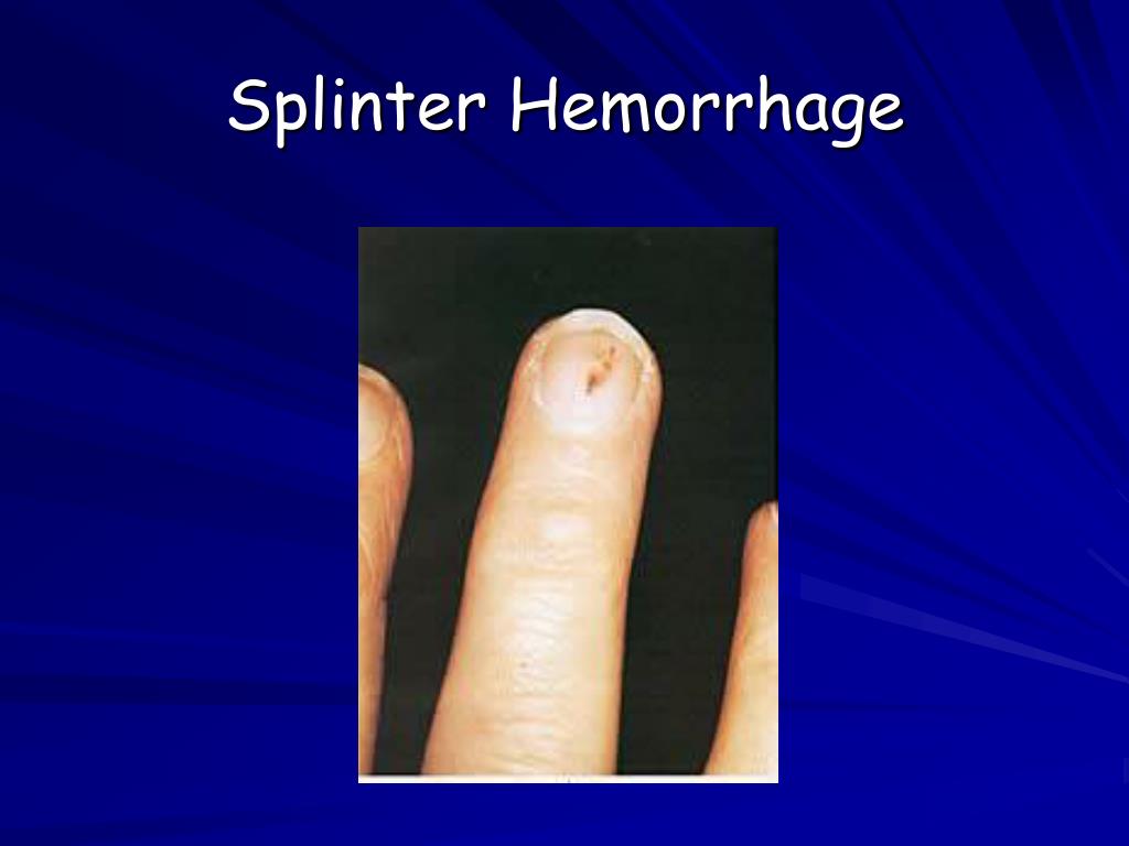 PPT Infective Endocarditis PowerPoint Presentation, free download