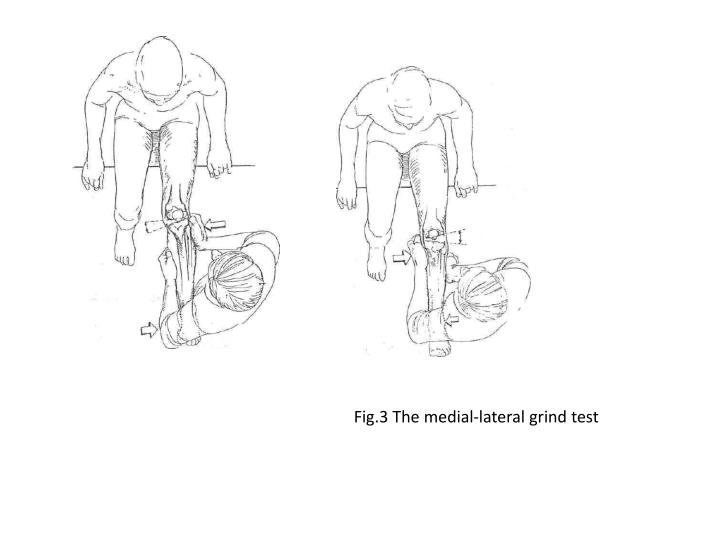 PPT Fig. 2 . The McMurray test for meniscal tears. PowerPoint