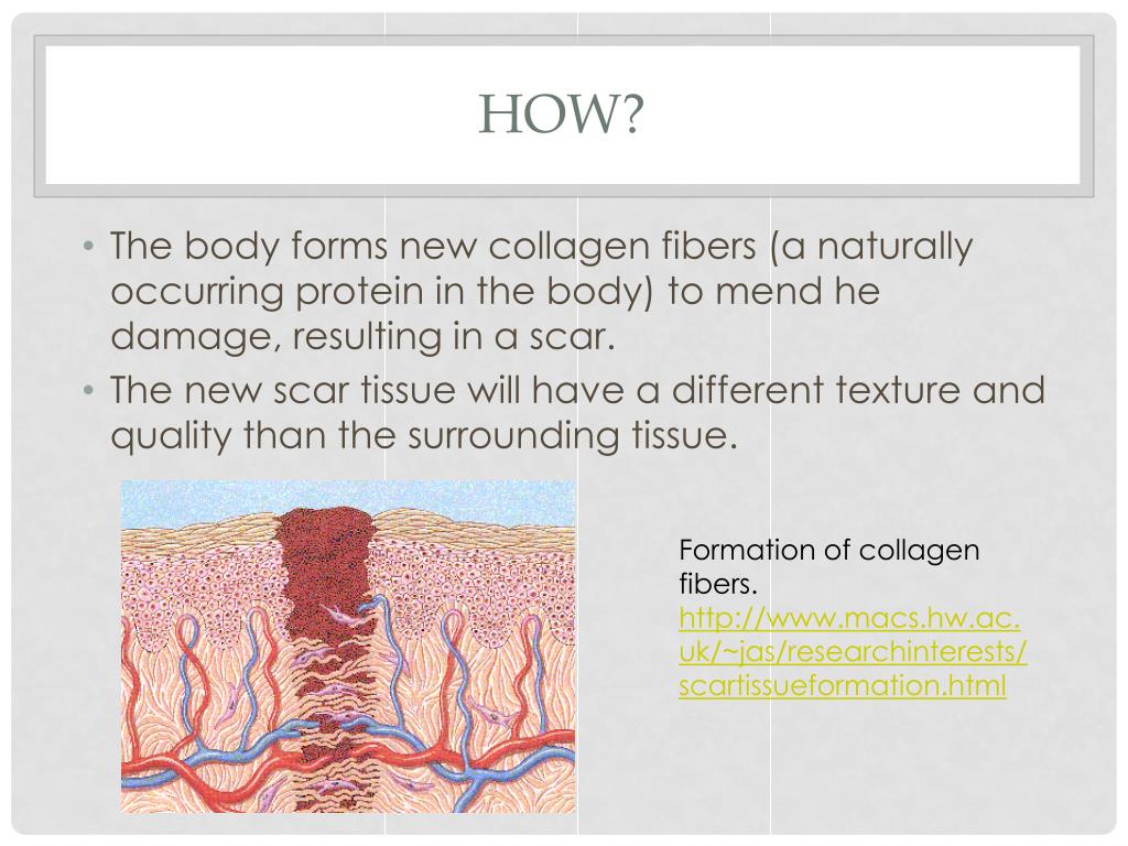 PPT How and why do scars form? PowerPoint Presentation, free download