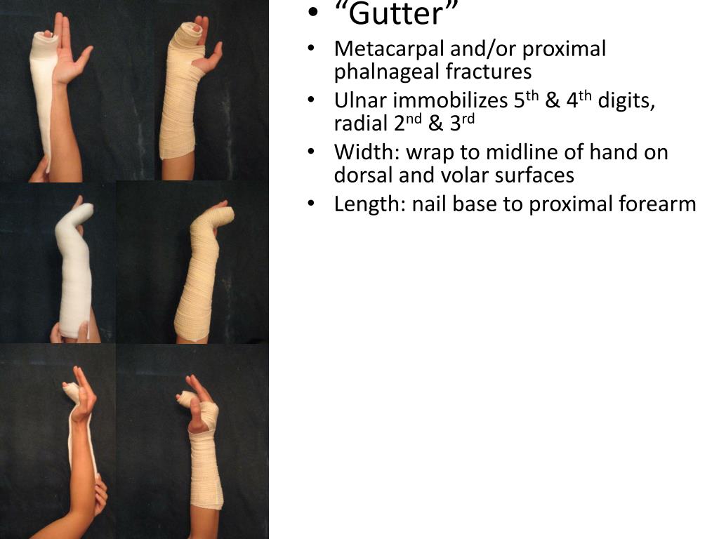 PPT Splinting PowerPoint Presentation, free download ID5364828