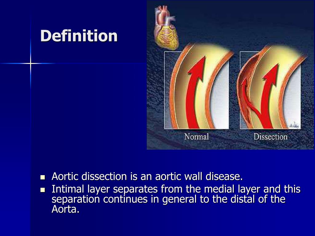 PPT AORTIC DISSECTION PowerPoint Presentation, free download ID5387903
