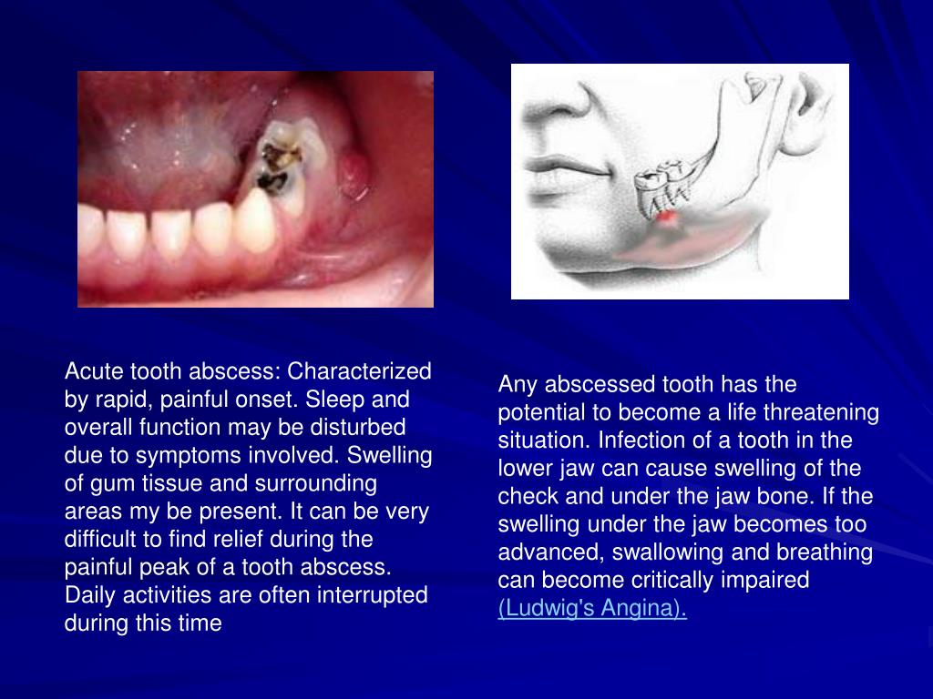 PPT Acute apical periodontitis (parodontitis apicalis