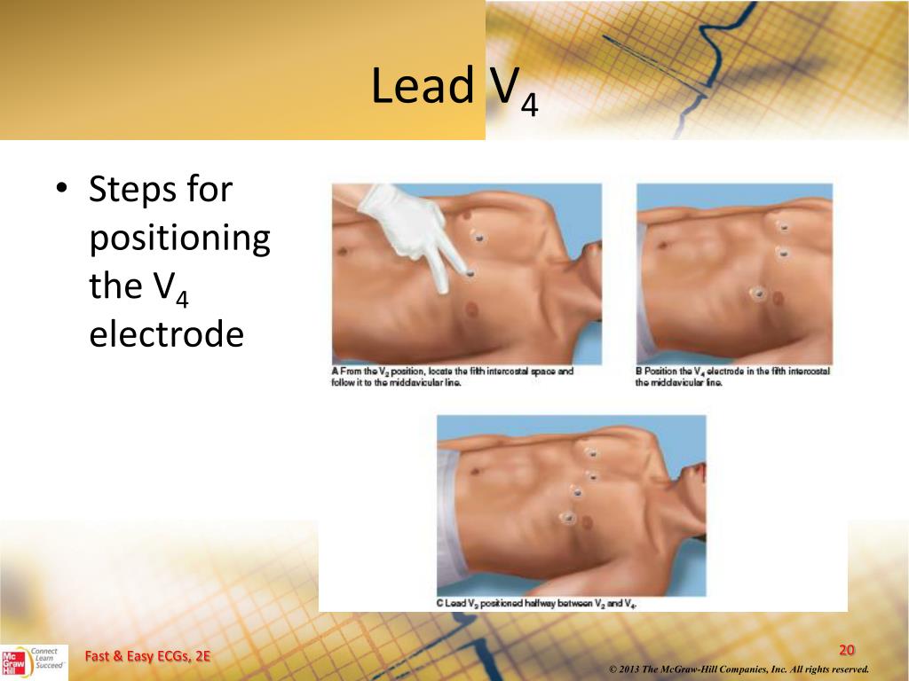 PPT 12Lead ECGs and Electrical Axis PowerPoint Presentation, free download ID5490745