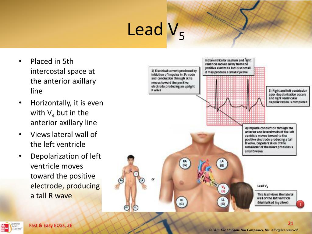 PPT 12Lead ECGs and Electrical Axis PowerPoint Presentation, free download ID5490745