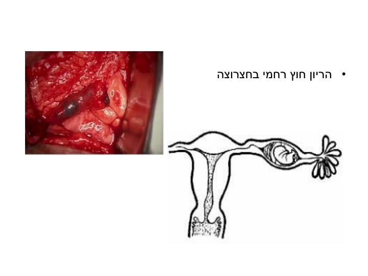 PPT ECTOPIC PREGNANCY PowerPoint Presentation ID5495365