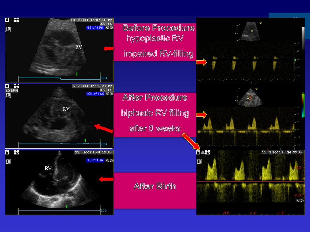 PPT Anomalies of the PV and RV PowerPoint Presentation, free download