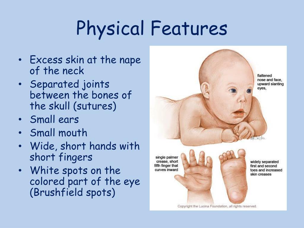 PPT Down Syndrome and their Education PowerPoint Presentation, free