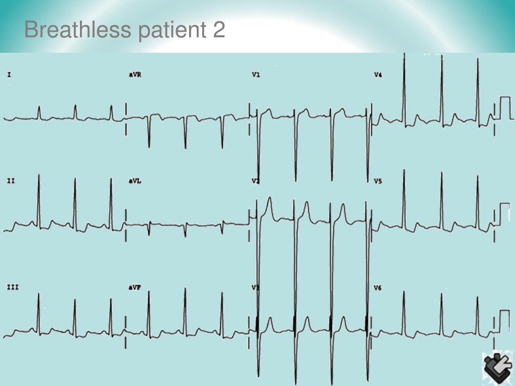 PPT HEART FAILURE AND BREATHLESSNESS IN END STAGE CARE PowerPoint