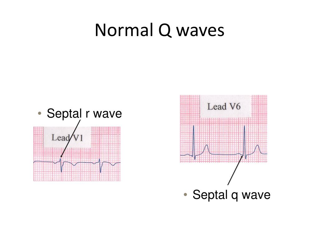 PPT ECG Interpretation PowerPoint Presentation, free download ID