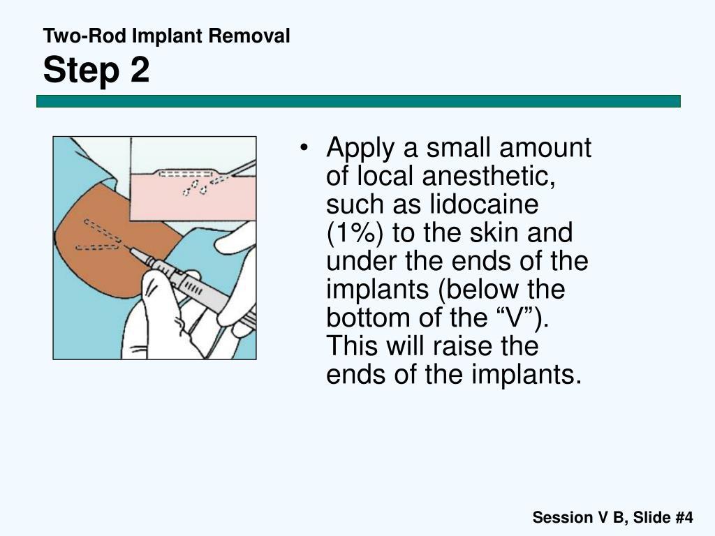 PPT Contraceptive Implants Session V B TwoRod Implant Removal