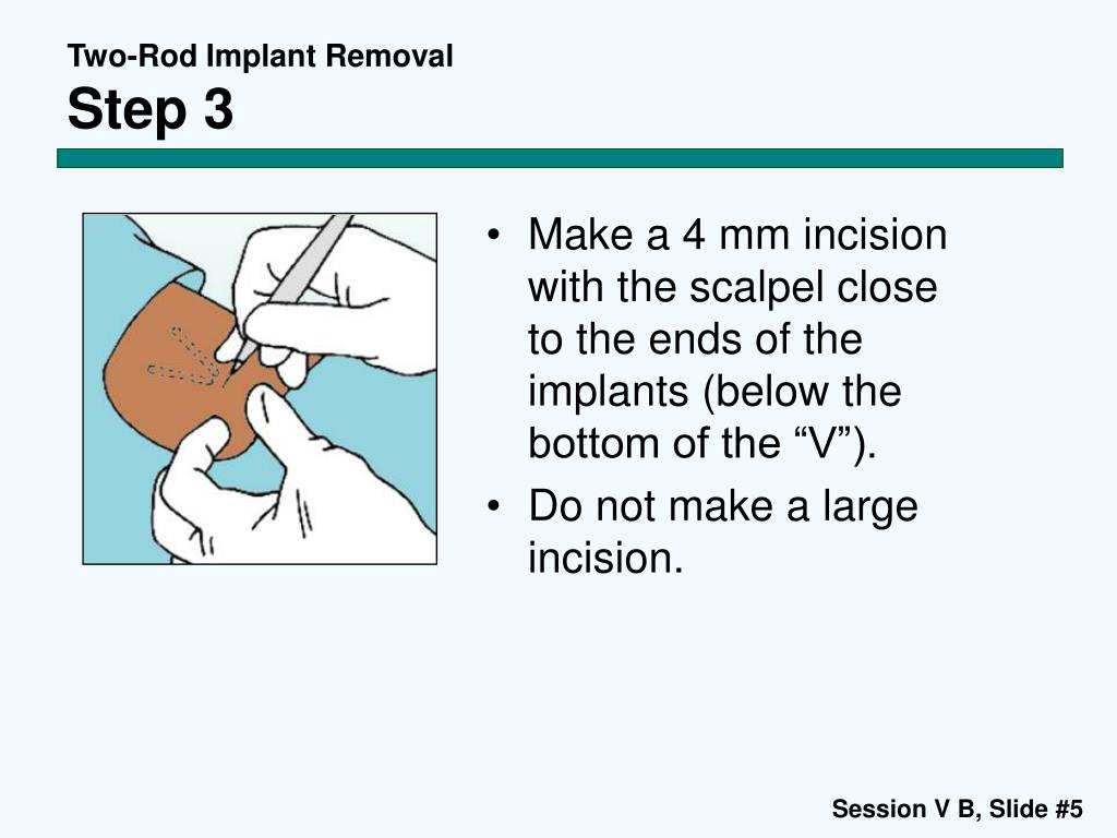 PPT Contraceptive Implants Session V B TwoRod Implant Removal