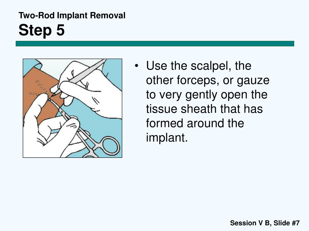 PPT Contraceptive Implants Session V B TwoRod Implant Removal
