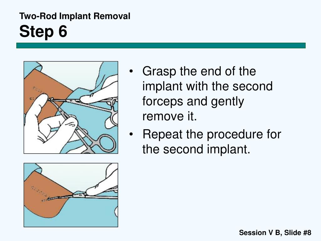 PPT Contraceptive Implants Session V B TwoRod Implant Removal