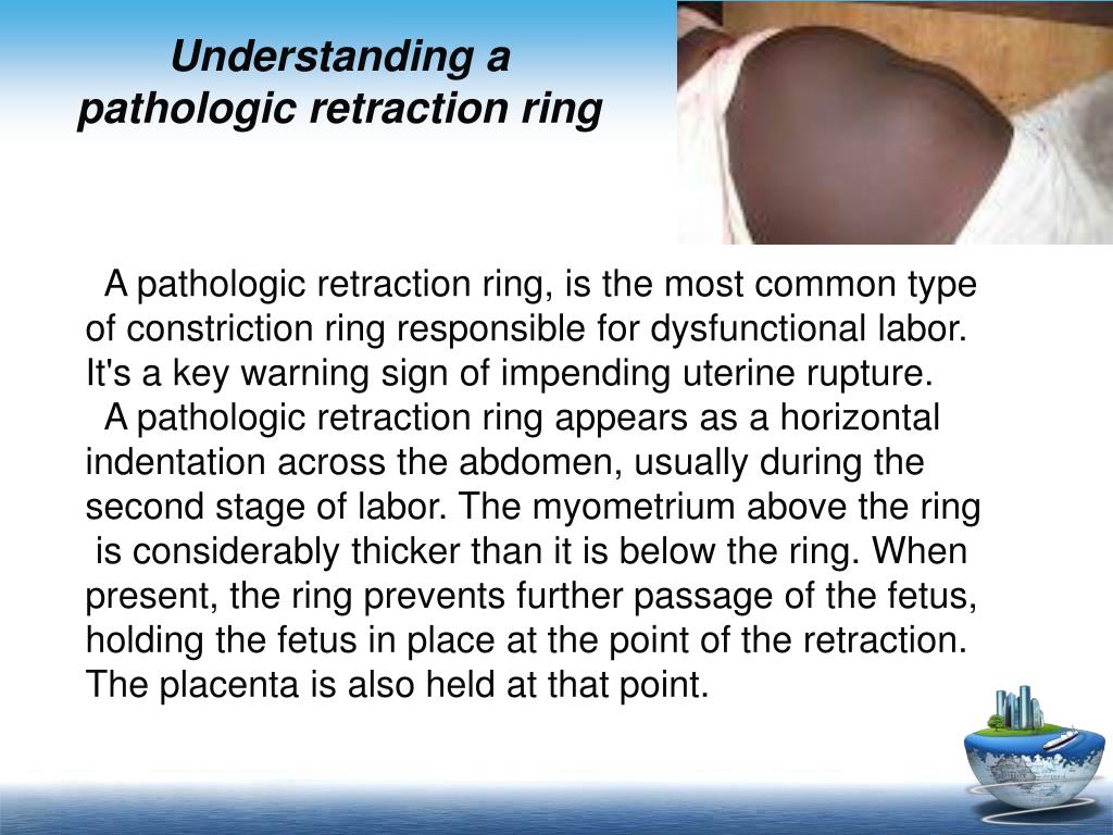 PPT Fetal distress, Abnormal labor, Obstetric complications during