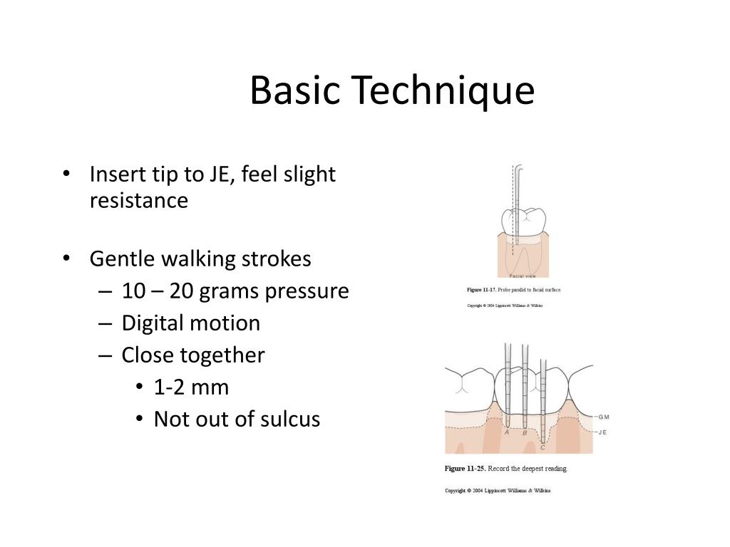 PPT The Periodontal Probe PowerPoint Presentation, free download ID