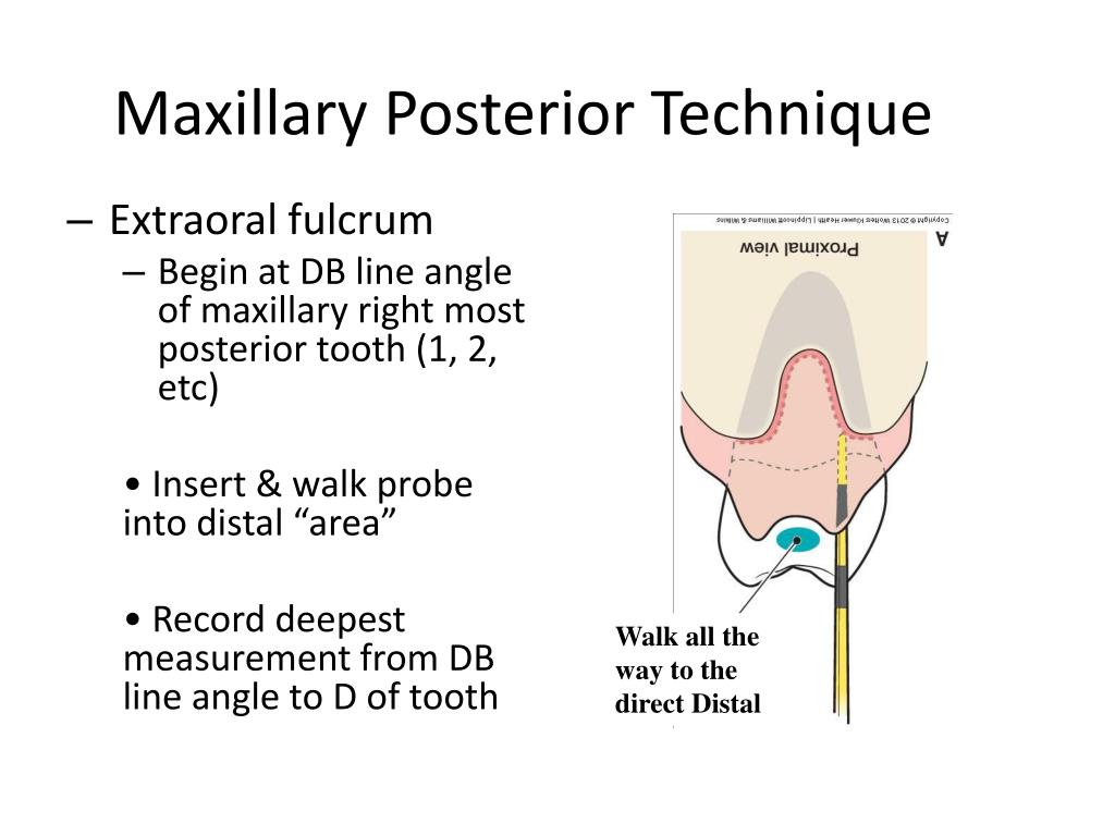 PPT The Periodontal Probe PowerPoint Presentation, free download ID