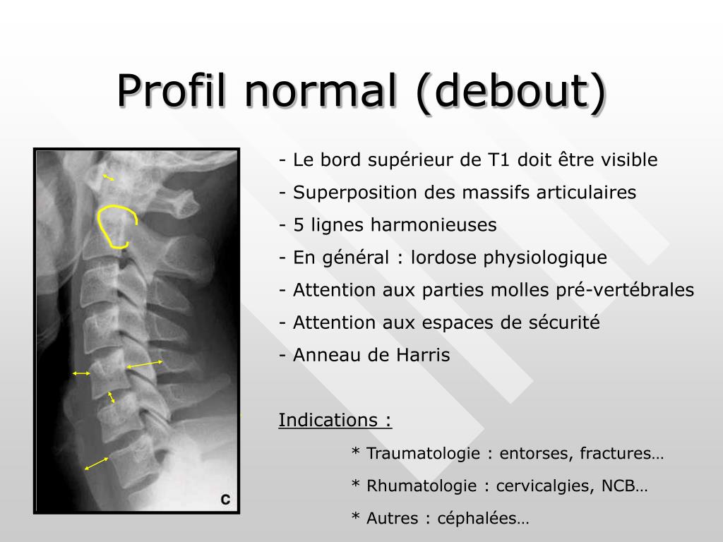 TDM normale du thorax en coupe axiale IMAIOS